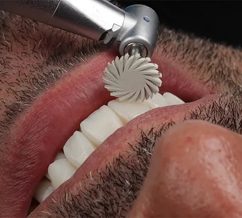Amostra do dente | GC Digital Clinic