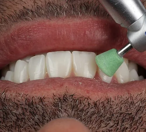 Amostras dos dentes | GC Digital Clinic